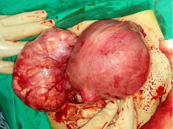  Uterusun arka ve ön duvarında yerleşmiş iki adet dev myom. Bu hastada sık idrara çıkma ve kabızlıkla birlikte kansızlık şikayeti mevcuttu. Toplamda 6 adet myom rahim korunarak çıkarıldı.